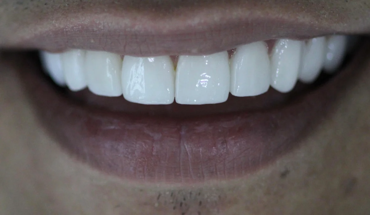 Patient smile transformation 10