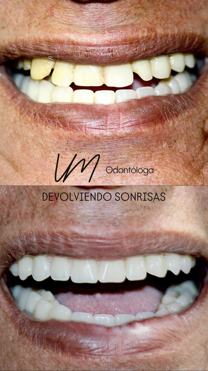 Patient smile transformation 11