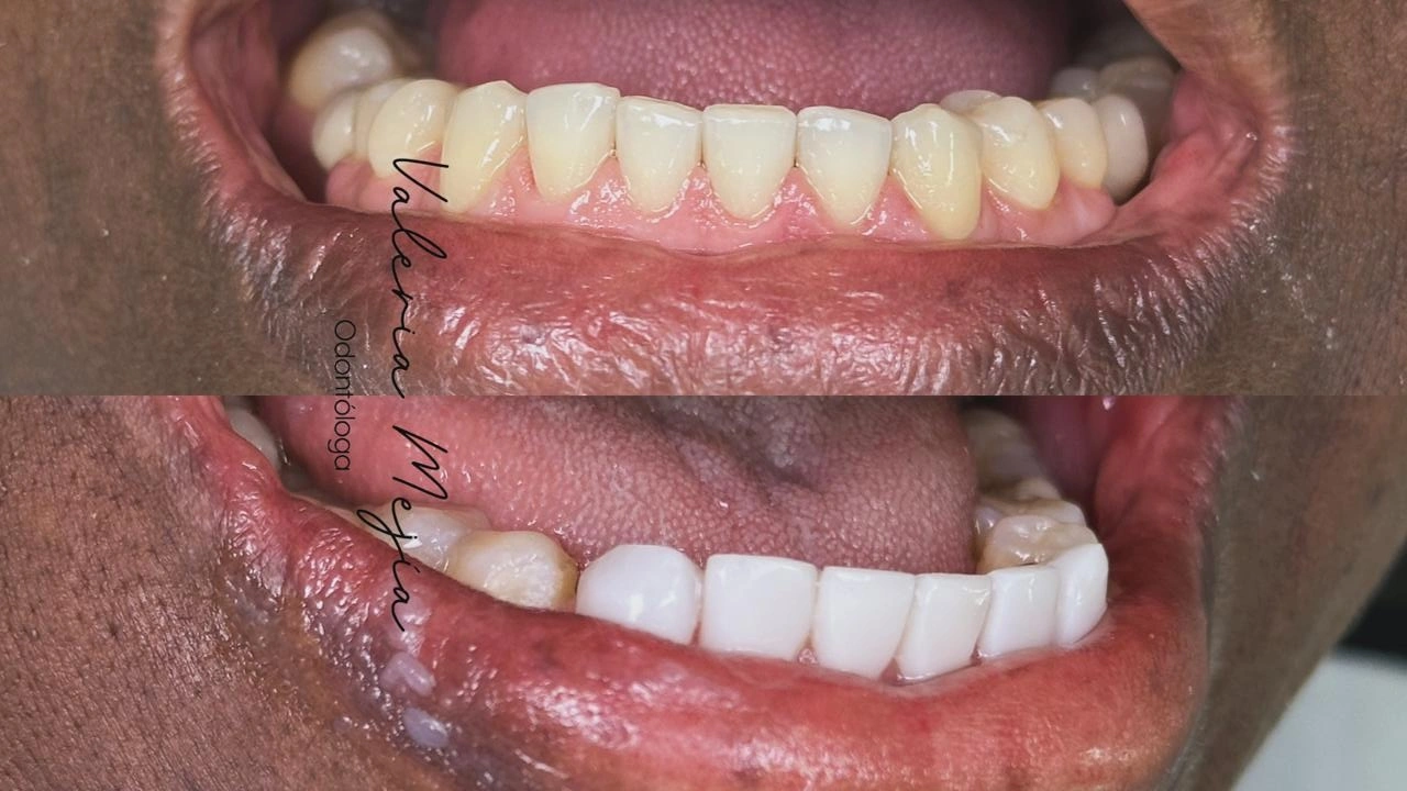 Patient smile transformation 13