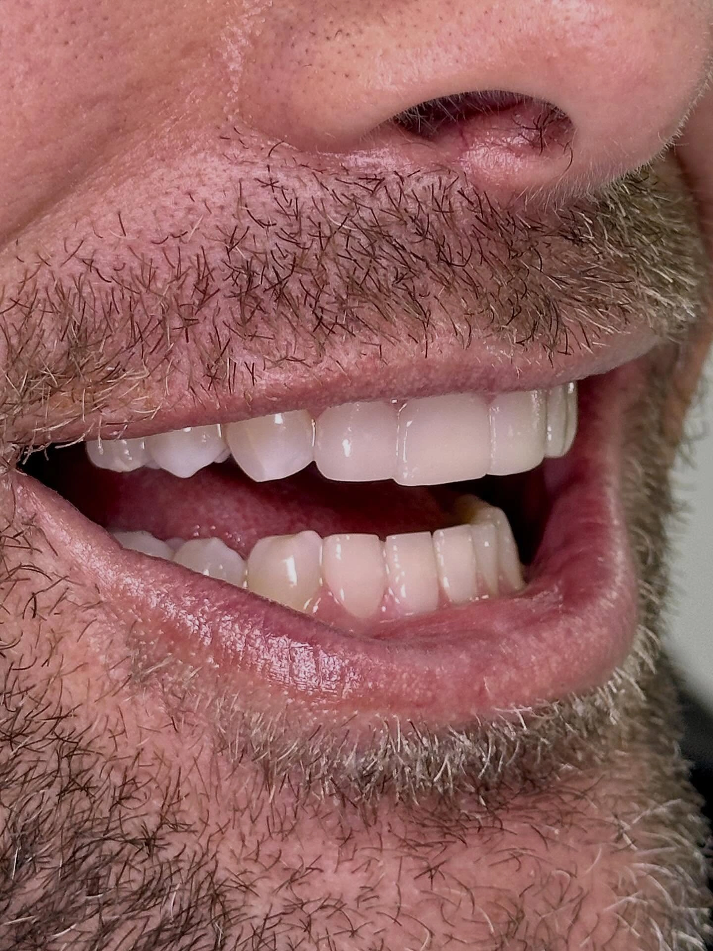 Patient smile transformation 3