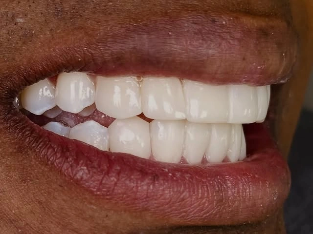 Patient smile transformation 4