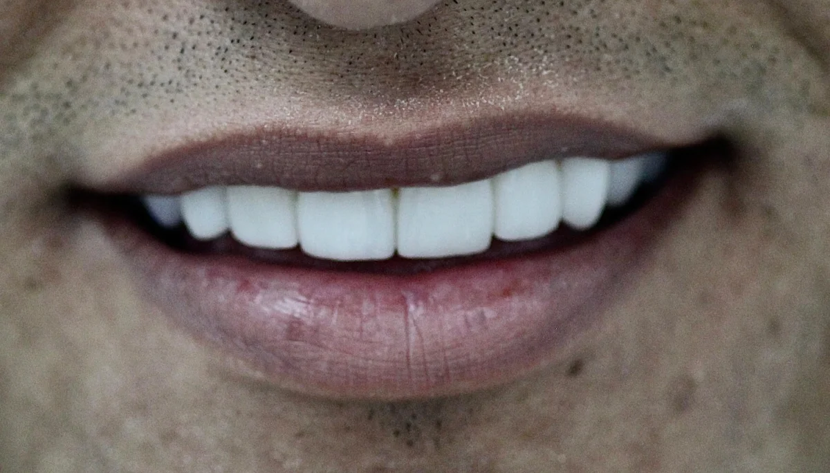 Patient smile transformation 9